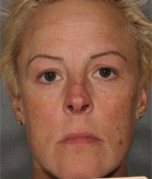 Patient # 72995 Before Photo # 1